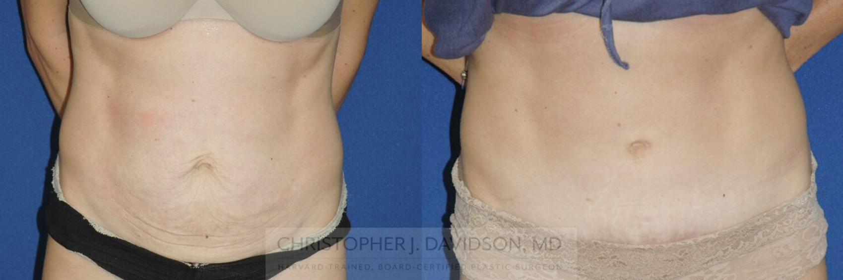 Tummy Tuck (Abdominoplasty) Case 117 Before & After View #1 | Wellesley, MA | Christopher J. Davidson, MD