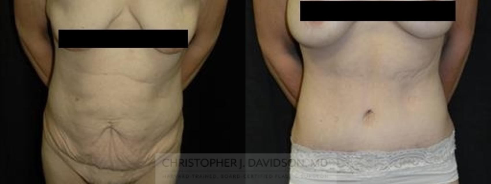 Tummy Tuck (Abdominoplasty) Case 119 Before & After View #1 | Boston, MA | Christopher J. Davidson, MD