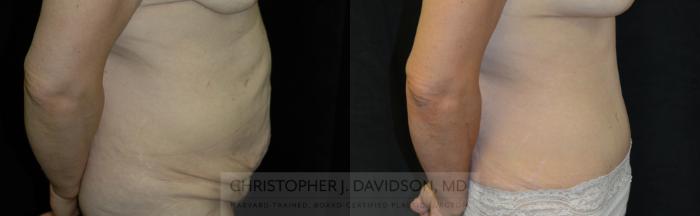 Tummy Tuck (Abdominoplasty) Case 119 Before & After View #3 | Boston, MA | Christopher J. Davidson, MD