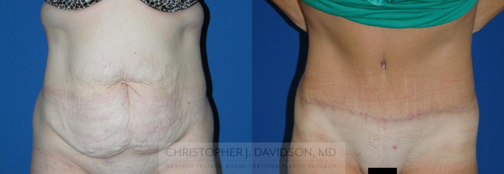 Tummy Tuck (Abdominoplasty) Case 142 Before & After View #1 | Boston, MA | Christopher J. Davidson, MD