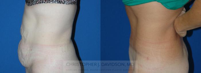 Tummy Tuck (Abdominoplasty) Case 142 Before & After View #2 | Boston, MA | Christopher J. Davidson, MD