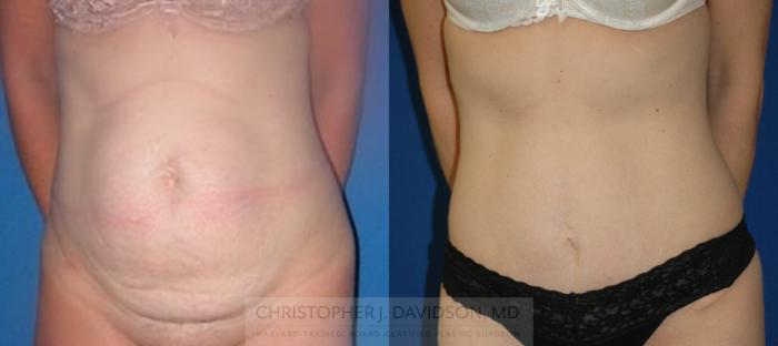 Tummy Tuck (Abdominoplasty) Case 173 Before & After View #1 | Wellesley, MA | Christopher J. Davidson, MD