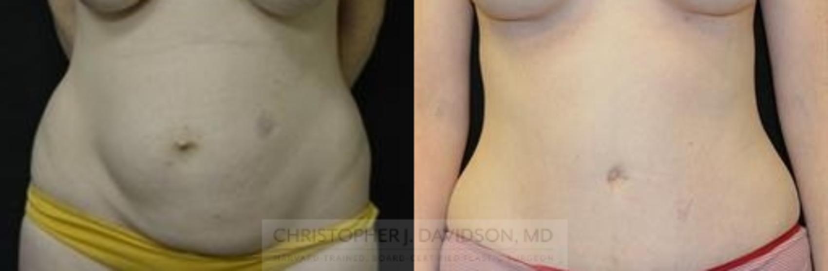 Tummy Tuck (Abdominoplasty) Case 184 Before & After View #1 | Wellesley, MA | Christopher J. Davidson, MD