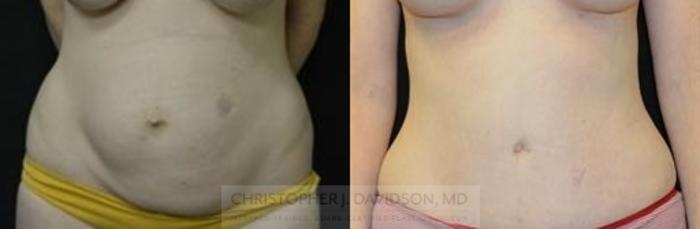 Tummy Tuck (Abdominoplasty) Case 184 Before & After View #1 | Boston, MA | Christopher J. Davidson, MD