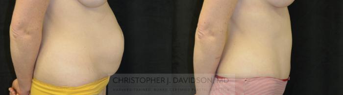 Tummy Tuck (Abdominoplasty) Case 184 Before & After View #2 | Boston, MA | Christopher J. Davidson, MD