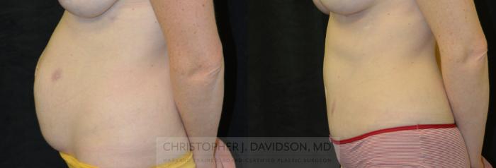 Tummy Tuck (Abdominoplasty) Case 184 Before & After View #3 | Boston, MA | Christopher J. Davidson, MD
