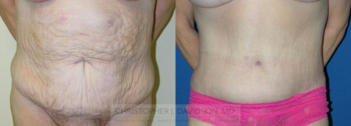 Tummy Tuck (Abdominoplasty) Case 227 Before & After View #1 | Wellesley, MA | Christopher J. Davidson, MD