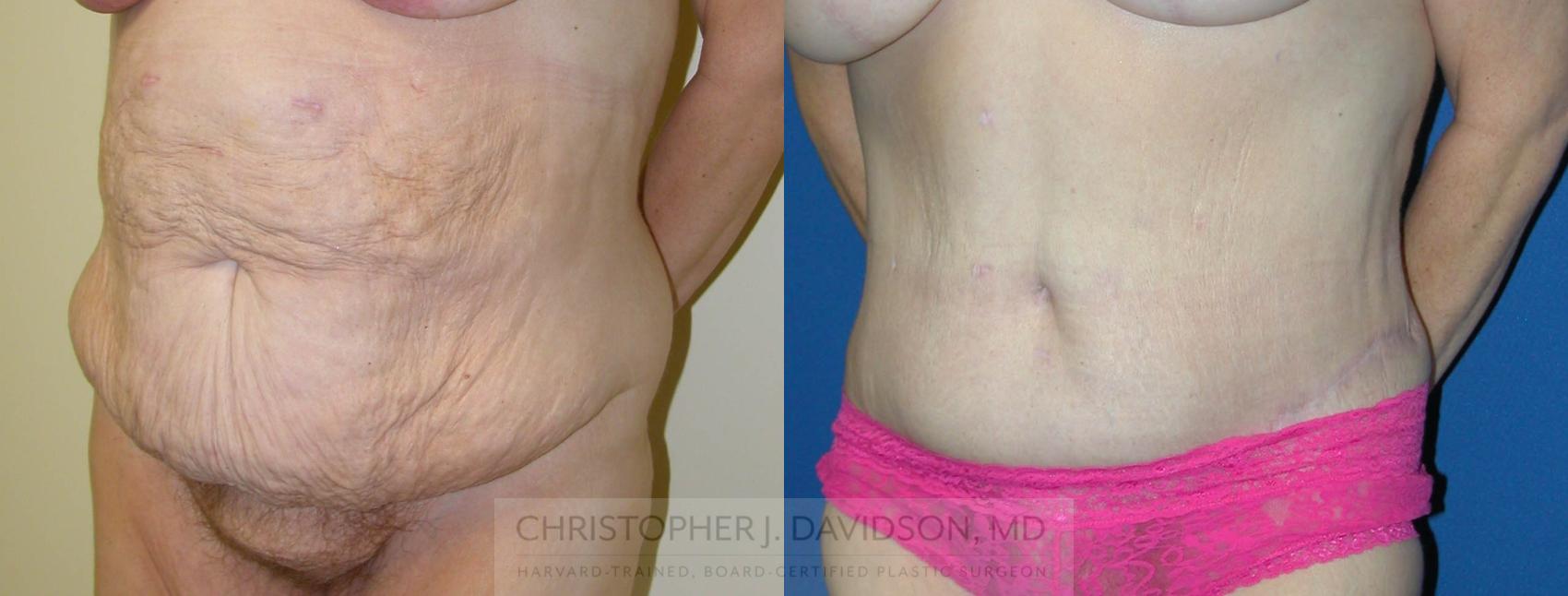 Tummy Tuck (Abdominoplasty) Case 227 Before & After View #2 | Wellesley, MA | Christopher J. Davidson, MD