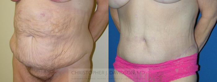 Tummy Tuck (Abdominoplasty) Case 227 Before & After View #2 | Boston, MA | Christopher J. Davidson, MD