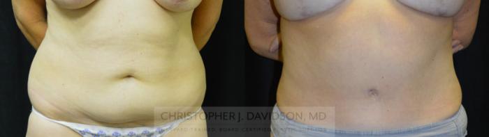 Tummy Tuck (Abdominoplasty) Case 248 Before & After View #1 | Boston, MA | Christopher J. Davidson, MD