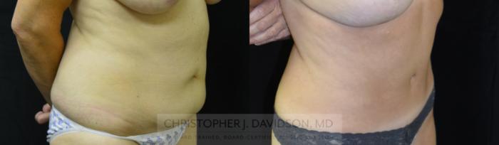 Tummy Tuck (Abdominoplasty) Case 248 Before & After View #2 | Boston, MA | Christopher J. Davidson, MD