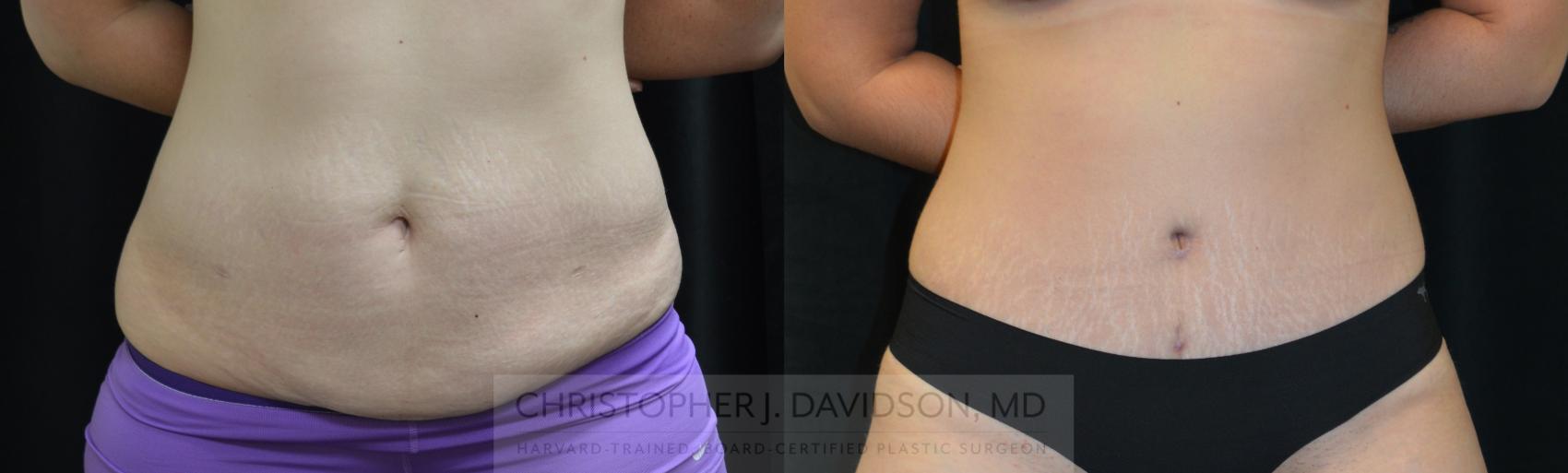 Liposuction Case 259 Before & After Front | Wellesley, MA | Christopher J. Davidson, MD