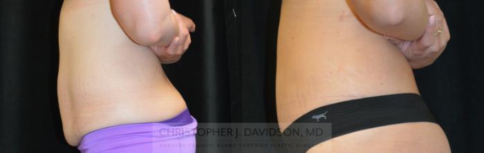 Tummy Tuck (Abdominoplasty) Case 259 Before & After Left Side | Wellesley, MA | Christopher J. Davidson, MD