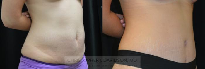 Tummy Tuck (Abdominoplasty) Case 259 Before & After Right Oblique | Wellesley, MA | Christopher J. Davidson, MD