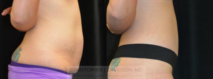 Tummy Tuck (Abdominoplasty) Case 259 Before & After Right Side | Wellesley, MA | Christopher J. Davidson, MD