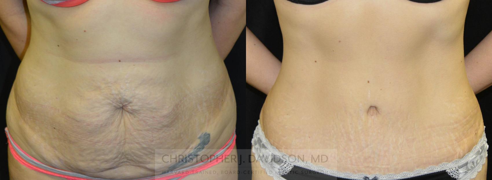 Tummy Tuck (Abdominoplasty) Case 26 Before & After View #1 | Wellesley & Boston, MA | Christopher J. Davidson, MD