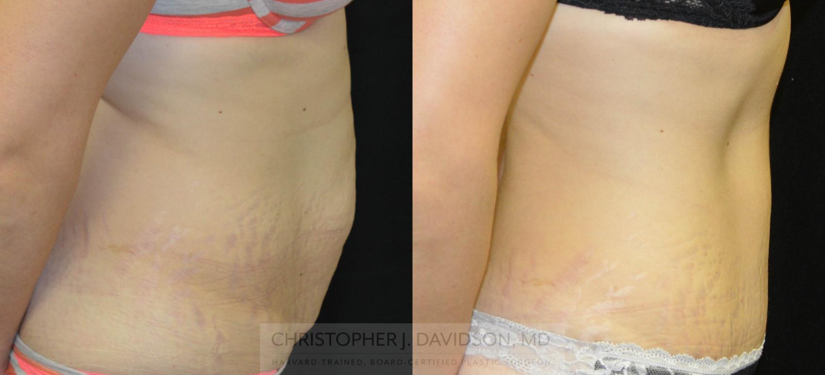 Tummy Tuck (Abdominoplasty) Case 26 Before & After View #2 | Wellesley, MA | Christopher J. Davidson, MD