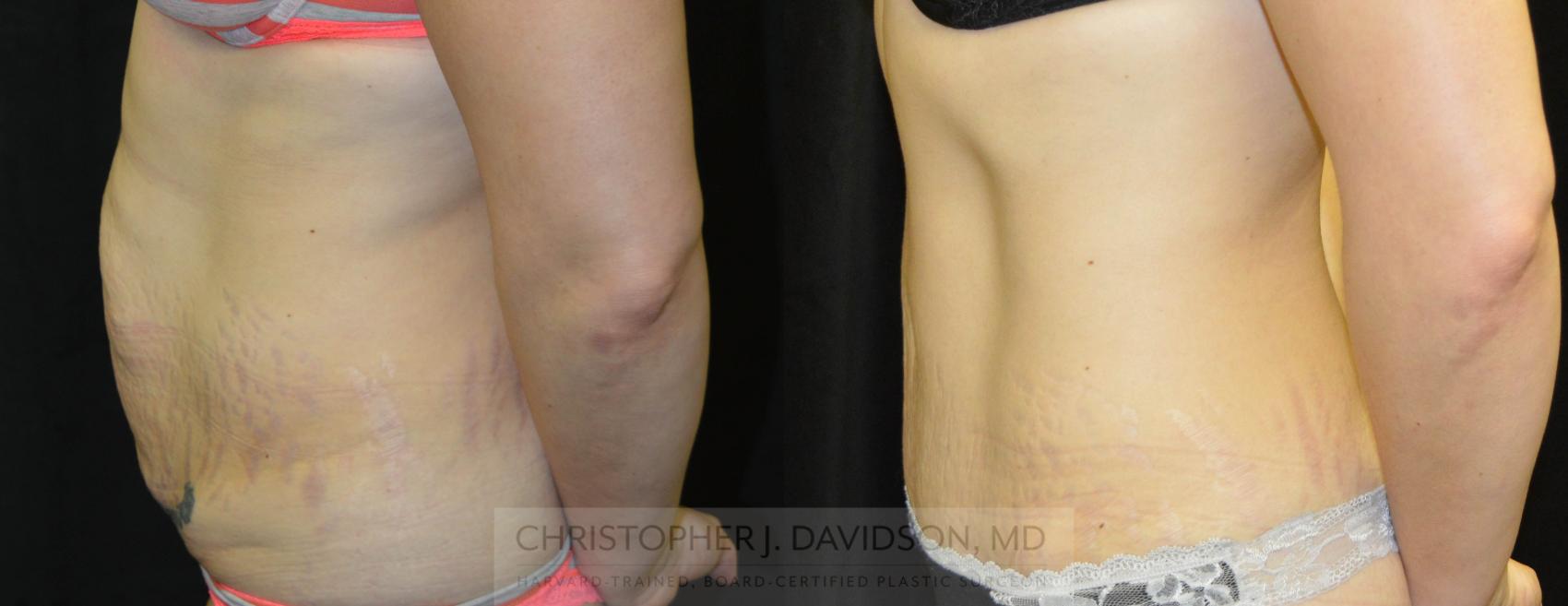 Tummy Tuck (Abdominoplasty) Case 26 Before & After View #3 | Wellesley, MA | Christopher J. Davidson, MD
