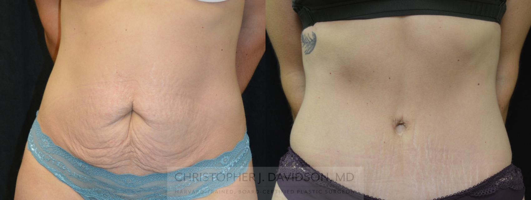 Tummy Tuck (Abdominoplasty) Case 262 Before & After Front | Wellesley, MA | Christopher J. Davidson, MD