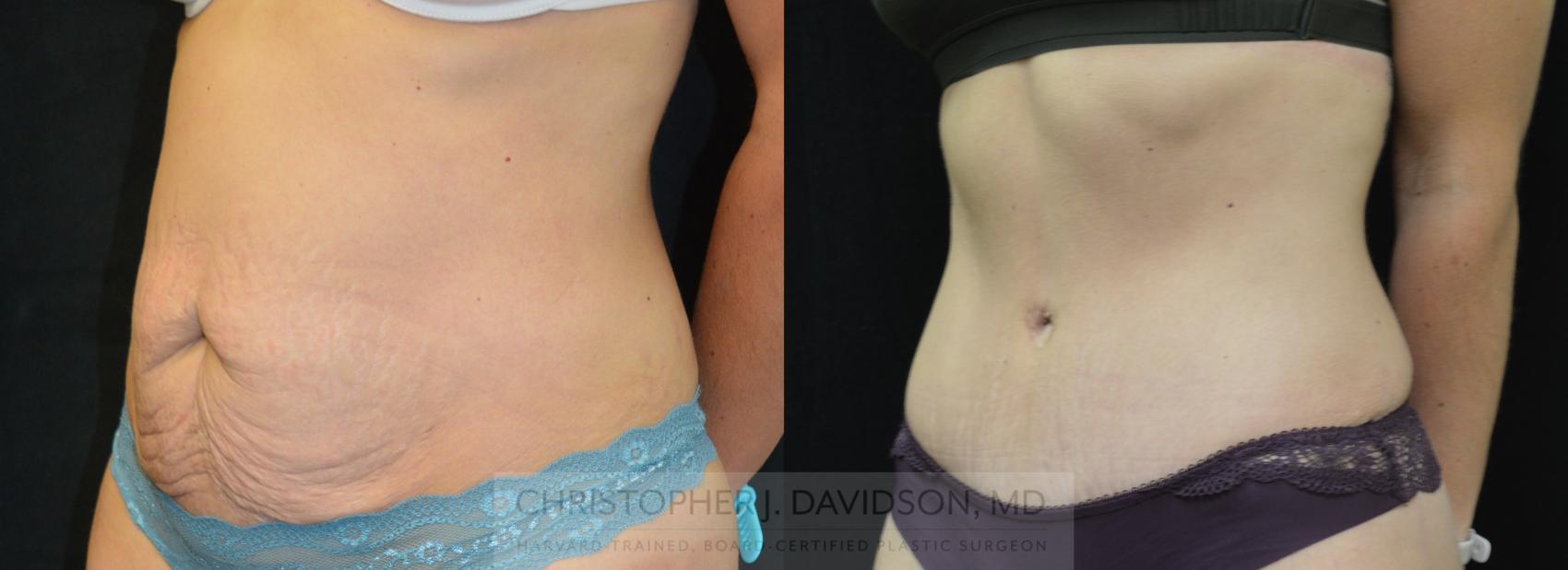 Tummy Tuck (Abdominoplasty) Case 262 Before & After Left Oblique | Boston, MA | Christopher J. Davidson, MD