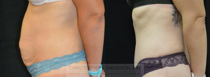 Tummy Tuck (Abdominoplasty) Case 262 Before & After Left Side | Wellesley, MA | Christopher J. Davidson, MD