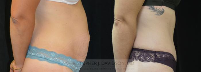 Tummy Tuck (Abdominoplasty) Case 262 Before & After Right Side | Wellesley, MA | Christopher J. Davidson, MD