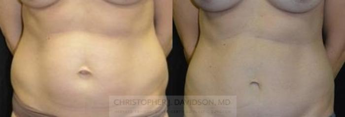 Tummy Tuck (Abdominoplasty) Case 27 Before & After View #1 | Wellesley, MA | Christopher J. Davidson, MD