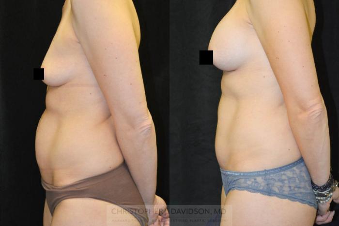 Tummy Tuck (Abdominoplasty) Case 27 Before & After View #2 | Wellesley, MA | Christopher J. Davidson, MD