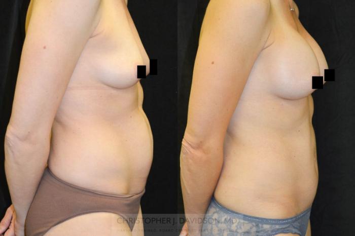 Tummy Tuck (Abdominoplasty) Case 27 Before & After View #3 | Wellesley, MA | Christopher J. Davidson, MD