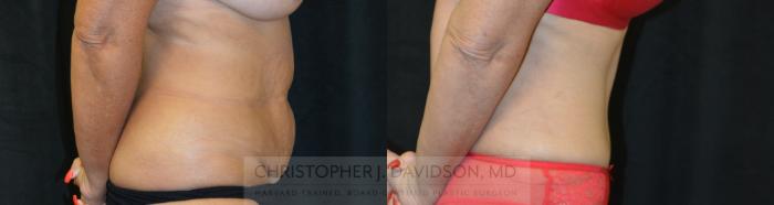 Tummy Tuck (Abdominoplasty) Case 271 Before & After Right Side | Boston, MA | Christopher J. Davidson, MD