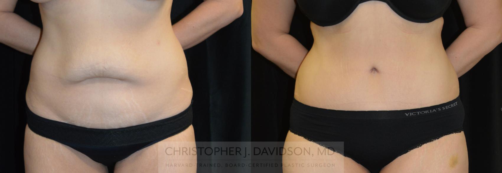 Tummy Tuck (Abdominoplasty) Case 283 Before & After Front | Boston, MA | Christopher J. Davidson, MD