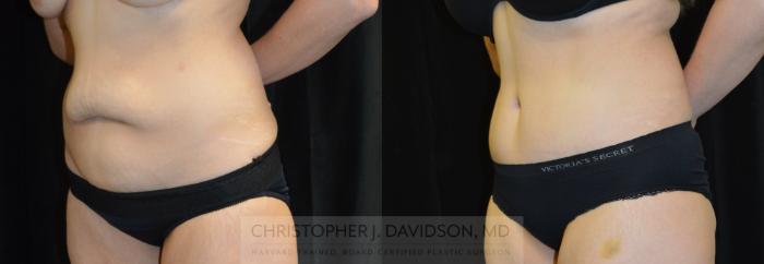 Tummy Tuck (Abdominoplasty) Case 283 Before & After Left Oblique | Wellesley, MA | Christopher J. Davidson, MD