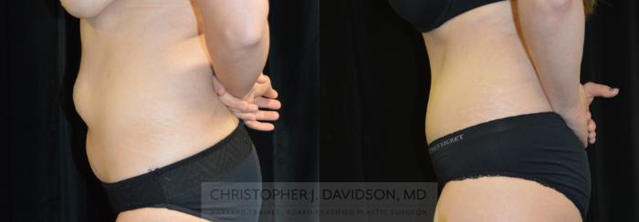 Tummy Tuck (Abdominoplasty) Case 283 Before & After Left Side | Wellesley, MA | Christopher J. Davidson, MD