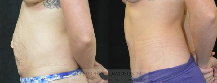 Tummy Tuck (Abdominoplasty) Case 295 Before & After Left Side | Boston, MA | Christopher J. Davidson, MD