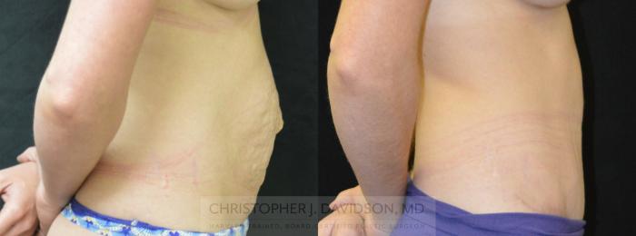 Tummy Tuck (Abdominoplasty) Case 295 Before & After Right Side | Boston, MA | Christopher J. Davidson, MD