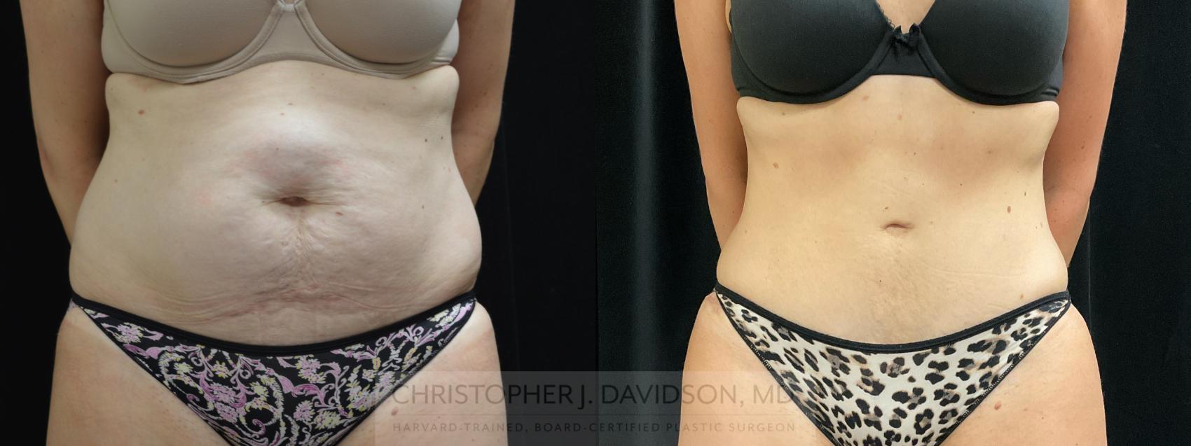 Tummy Tuck (Abdominoplasty) Case 305 Before & After Front | Boston, MA | Christopher J. Davidson, MD