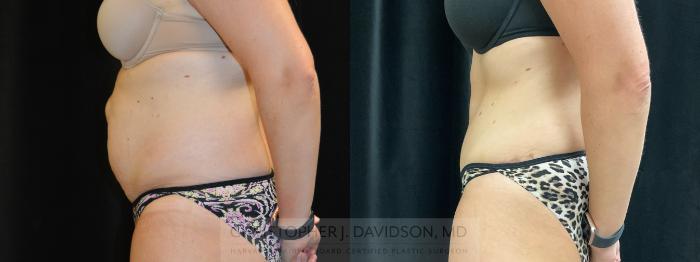 Tummy Tuck (Abdominoplasty) Case 305 Before & After Left Side | Boston, MA | Christopher J. Davidson, MD