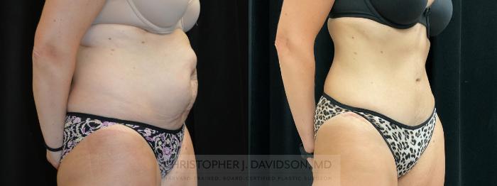 Tummy Tuck (Abdominoplasty) Case 305 Before & After Right Oblique | Boston, MA | Christopher J. Davidson, MD