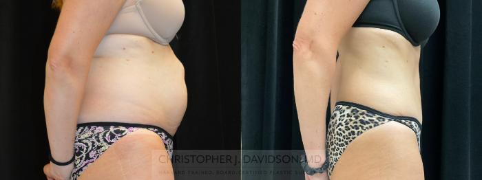 Tummy Tuck (Abdominoplasty) Case 305 Before & After Right Side | Boston, MA | Christopher J. Davidson, MD