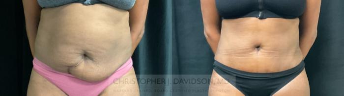 Tummy Tuck (Abdominoplasty) Case 307 Before & After Front | Boston, MA | Christopher J. Davidson, MD
