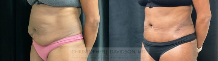 Tummy Tuck (Abdominoplasty) Case 307 Before & After Left Oblique | Boston, MA | Christopher J. Davidson, MD