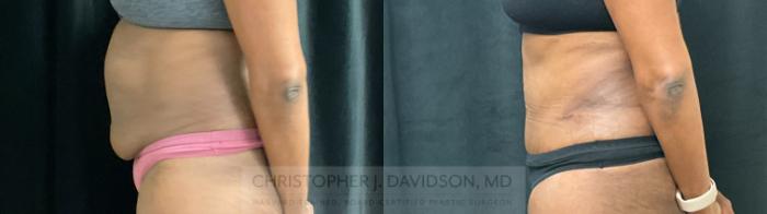 Tummy Tuck (Abdominoplasty) Case 307 Before & After Left Side | Boston, MA | Christopher J. Davidson, MD