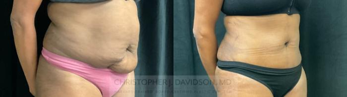 Tummy Tuck (Abdominoplasty) Case 307 Before & After Right Oblique | Boston, MA | Christopher J. Davidson, MD