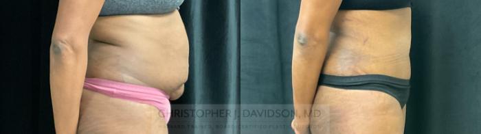 Tummy Tuck (Abdominoplasty) Case 307 Before & After Right Side | Boston, MA | Christopher J. Davidson, MD
