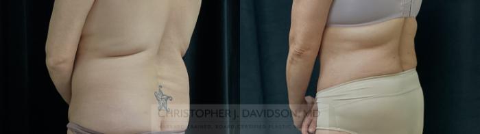 Liposuction Case 310 Before & After Back - Left Oblique | Boston, MA | Christopher J. Davidson, MD