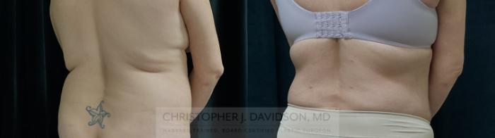 Liposuction Case 310 Before & After Back - Right Oblique | Boston, MA | Christopher J. Davidson, MD
