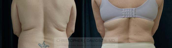 Liposuction Case 310 Before & After Back | Boston, MA | Christopher J. Davidson, MD
