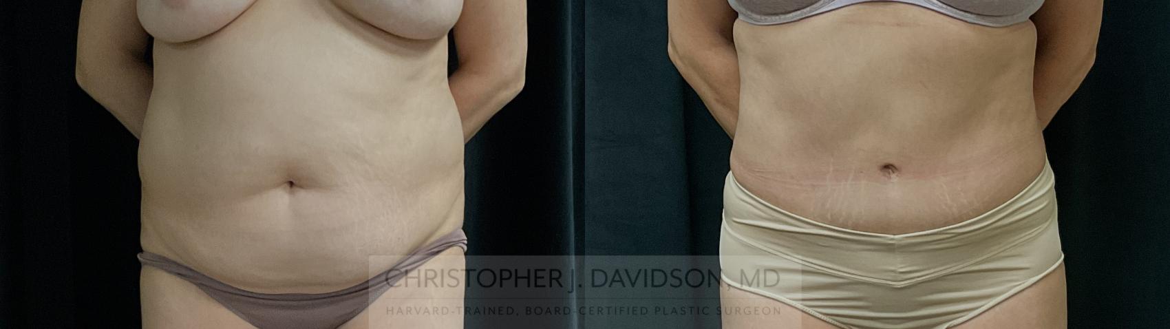 Liposuction Case 310 Before & After Front | Boston, MA | Christopher J. Davidson, MD