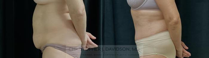 Liposuction Case 310 Before & After Left Side | Boston, MA | Christopher J. Davidson, MD