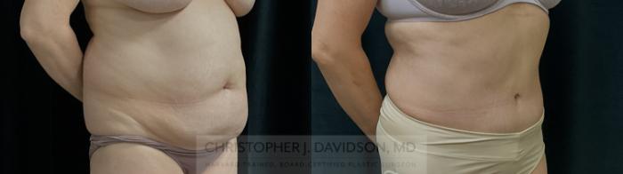 Tummy Tuck (Abdominoplasty) Case 310 Before & After Right Oblique | Boston, MA | Christopher J. Davidson, MD